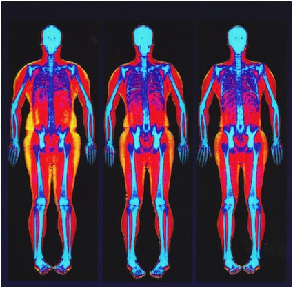 bone density test results chart Lovely DEXA scan – top information on body fat